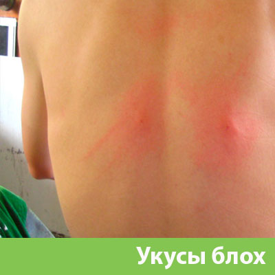 Укусы блох в Барнауле