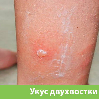 Укус двухвостки в Барнауле