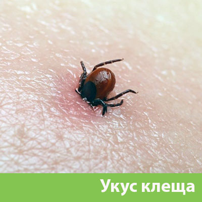 Укус клеща в Барнауле