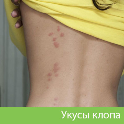 Профессиональное уничтожение клопов в Барнауле